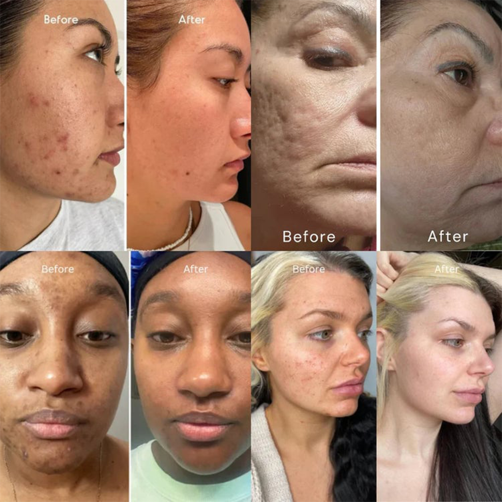 🎉 Purelora® Instant Neck Lifting Cream — 🍀 Enriched with Retinol and Hyaluronic Acid | Helps firm neck skin, reduce wrinkles, and improve the appearance of a double chin.