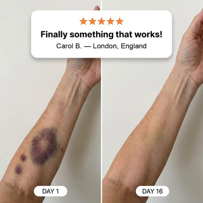 🇨🇦Over 100,000 units sold🏆 - PURELORA® Cream to repair bruises and strengthen skin