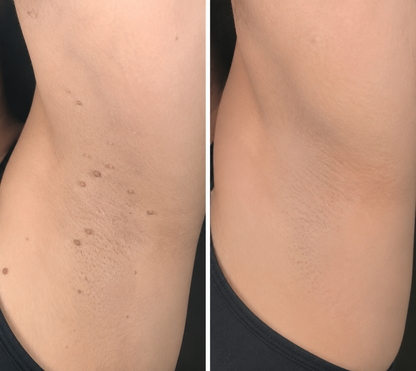 🏥𝐏𝐮𝐫𝐞𝐥𝐨𝐫𝐚®2-in-1 Microneedle & Hydrocolloid Patch🍀| Removes Raised Moles, Acne, Flat Warts & Skin Tags | Helps Improve Wrinkles, Scars & Blemishes | Invisible Patches for Face & Body
