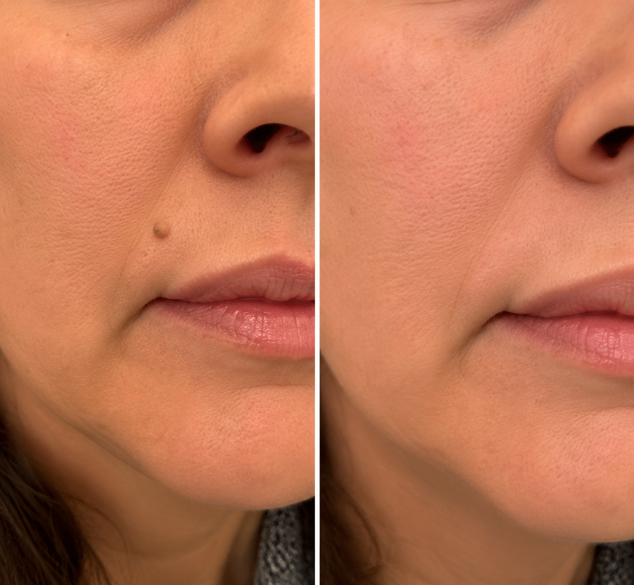 🏥𝐏𝐮𝐫𝐞𝐥𝐨𝐫𝐚®2-in-1 Microneedle & Hydrocolloid Patch🍀| Removes Raised Moles, Acne, Flat Warts & Skin Tags | Helps Improve Wrinkles, Scars & Blemishes | Invisible Patches for Face & Body