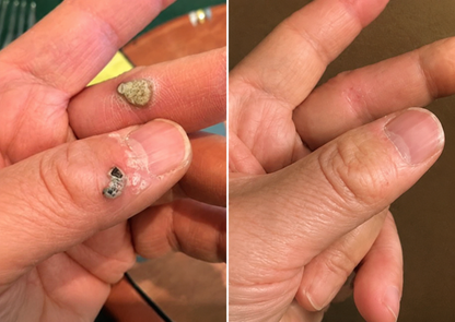 🏥𝐏𝐮𝐫𝐞𝐥𝐨𝐫𝐚®2-in-1 Microneedle & Hydrocolloid Patch🍀| Removes Raised Moles, Acne, Flat Warts & Skin Tags | Helps Improve Wrinkles, Scars & Blemishes | Invisible Patches for Face & Body